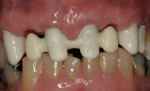 Figure 16  Try-in of the zirconia overcases. Note the room for porcelain and the ideal ovate pontic development from the buccal aspect.