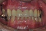 Figure 21  2-year post-insertion. Note that the soft-tissue contours are maintaining with slight gingival recession of 1.5 mm noted buccal to No. 11.