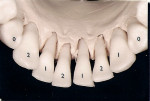 Figure 2  Implant distribution in mandible.