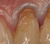 Fig 4. Patient No. 1 in 2016, with extrusion of tooth No. 15. Two different experiences in the same mouth, as shown in Figs 1–2 and Figs 3–4, underscore the unpredictability of extrusion.