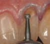 Fig 5. Patient No. 2 had an extraction of tooth No. 31 in 2009. Six years later, as shown, tooth No. 2 was extruded and needed to be removed due to caries.