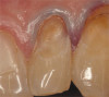 Fig 6. Patient No. 3 presented for an implant restoration at site No. 31 to eliminate pain due to chewing on the ridge from extruded tooth No. 2. Tooth No. 2 was equilibrated to eliminate the patient’s symptoms. In some patients, super-eruption can be severe enough to preclude an implant restoration due to a lack of restorative space.