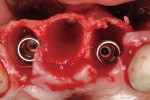 Figure 5  Implant placement.