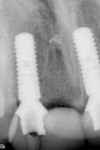 Figure 10  Postoperative periapical x-ray (PA).