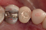 Figure 20  Provisional crown out of occlusal contact.