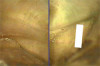 (Left) Grade I socket with an intact buccal plate demonstrating less than 25% bone loss; (Center) Grade II socket showing  ssure, dehiscence, and approximately 50% buccal plate loss; (Right) Grade III socket with more than 50% buccal plate loss.