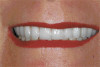 Fig 18. After application of the glaze to the tissue side of the crown/abutment assembly, it is then light polymerized.