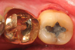 Figure 1  Plaque accumulation on the occlusal surfaces of a gold and amalgam restoration in a patient with poor oral hygiene.