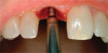 Fig 2. The opposing tooth would need to be adjusted intraorally by the dentist during the cementation of the crown.