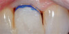 Fig 5. Tooth No. 18 is fully functional with an outstanding esthetic result.