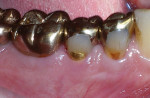 Figure 3  A gold foil restoration on tooth No. 29 and gold crown restoration on tooth No. 30 are adjacent to healthy gingiva. The patient has excellent oral hygiene.