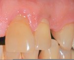 Figure 5  Class V composite restoration on tooth Nos. 9 and 10 associated with plaque-induced gingivitis in a patient with poor oral hygiene.