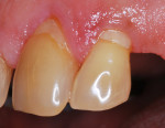 Figure 6  The same patient in Figure 5 had undergone oral hygiene instructions along with scaling and root planing. Note that the inflammation has receded and the gingiva is healthier.