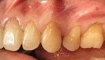 Figure 7  Tooth No. 13 has a composite restoration. Plaque has accumulated on the cervical areas of the adjacent teeth except on the restoration. No inflammation is seen adjacent to the restoration.