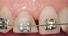 Placement of implant. Notice the bucco-palatal bone thickness gained from the ridge preservation technique.