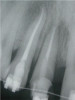 Clinical view of maxillary left lateral incisor implant in a healthy 48-year-old man. The swelling in the tissue surrounding this implant also bled on probing with depths up to 8 mm and exhibited purulence. The implant has been present for 14 years.