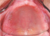 Fig 8. Note the lack of keratinized gingiva in a heavy smoker.