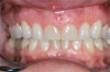 Fig 6. In this case, the laser fibers went into the gingival pocket and performed the decontamination, causing minimal bleeding and discomfort for the patient (Fig 5). Follow-up showed no inflammation or infection (Fig 6).