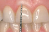 1. Glass ionomer cement (Fuji IX Extra, GC America) being placed as a dentin replacement in this disto-occlusal cavity preparation prior to placement of composite to replace the enamel functional surface.