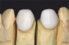 Fig 3. Occlusal view of the tooth before the restoration.