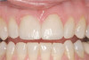 Fig 6. Finished Class II restoration using matrix system, flowable composite, and bulk-fill composite.