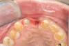 Fig 8. Partial overlay of the distal buccal cusp.
