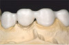 Fig 9. Clear matrix placed on tooth.