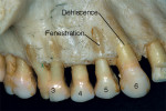 Figure  16  Dehiscence (tooth No. 5) and fenestration (teeth Nos. 3 and 6).