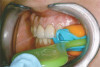 Fig 1. Space between the cervical portion of the teeth and the crestal soft tissues is indicative of a composite defect.