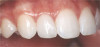 Fig 3. At 5 months, gingival health is indicated by the absence of inflammation and plaque. Smooth, dull facial surface of incisors is indicative of mild acid erosion.