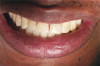 Fig 1. Multiple restorations decrease enamel and dentin strength, requiring full-coverage enhancement.