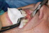 (4.) Preoperative occlusal view of upper arch.