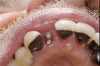 (14.) Postoperative occlusal view of lower arch.