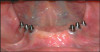 Fig 9. This screw-retained implant-supported provisional prosthesis is laboratory-processed.
