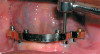 Fig 18. The provisional prosthesis is connected to the laboratory implant analog. (Case by Mina Bishara, BDS, DDS).