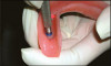 Fig 21. The impression coping is connected to the implant analog and resin is added to replicate the emergence profile of the provisional prosthesis.