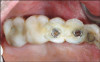 Fig 14. ICDAS code 4: Dark gray shadow visible in dentin in indicated area.