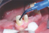Fig 8. Failing dentition in an 82-year-old patient currently diagnosed with tardive dyskensia.