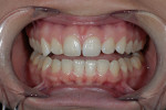 Figure 5  Slight cant revealed from teeth Nos. 6 through 11.