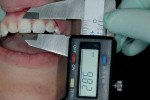 Figure 8  Digital measurement showing central incisors less than 10 mm in length.