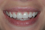 Figure 17  Final restorations—note pleasing balance between frame and teeth.
