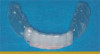 Fig 1. This panoramic view shows a challenging case with impacted third molars, several failing restorations, multiple non-restorable teeth, rampant decay, and periodontal disease.