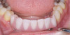 Fig 3. Flat red macules due to cheek biting or nipping present in a patient due to inadequate salivary lubrication.