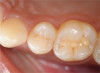 Figure 4 – Acid Induced Erosion of Teeth<sup>19</sup>
