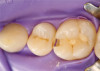 Figure 5 – Concavities on Buccal Surface of Eroded Teeth.<sup>25</sup>