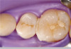 Figure 8 – 1.1% Sodium Fluoride Dentifrices