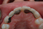 Figure 11  Palatal view of bridges at insertion.