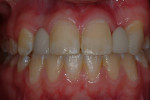 Figure 12  Final retracted view of anterior dentition prior to tooth whitening.