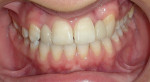 Figure 13  Final spacing teeth Nos. 8 and 9.