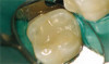 (8.) Postoperative view of the graft recipient site after 6 months showing healing progress with poor oral hygiene.
